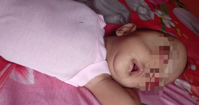 
					Derita Balita Idap Kanker Mata, Orang Tua Butuh Bantuan Biaya Berobat